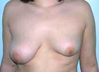 Ασυμμετρία στήθους και σωληνωτός μαστός