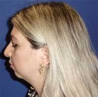 Chin surgery