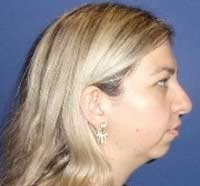 Genioplasty